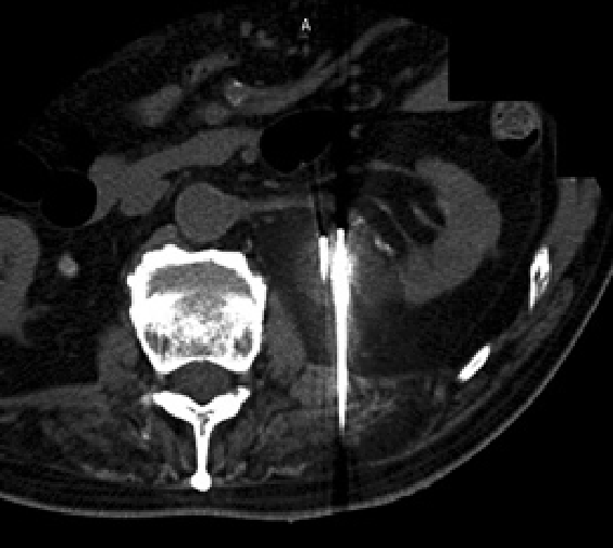 腎がん、骨軟部腫瘍に対する凍結療法2
