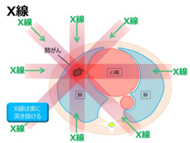 X線は奥に突き抜ける