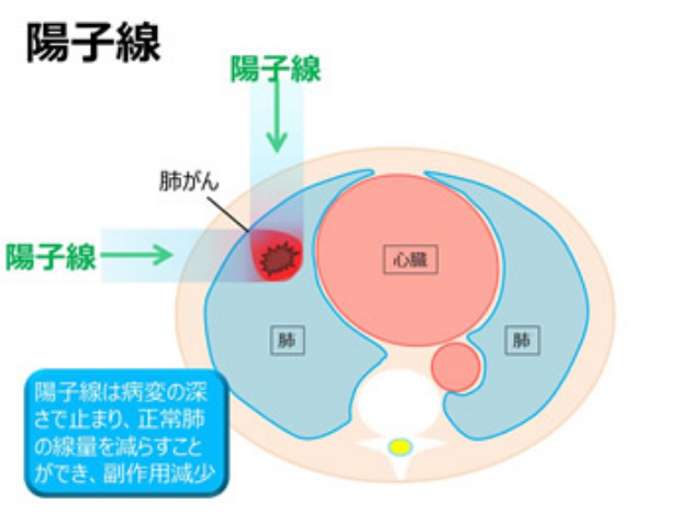 陽子線は病変の深さで止まり、正常肺の線量を減らすことができ、副作用減少