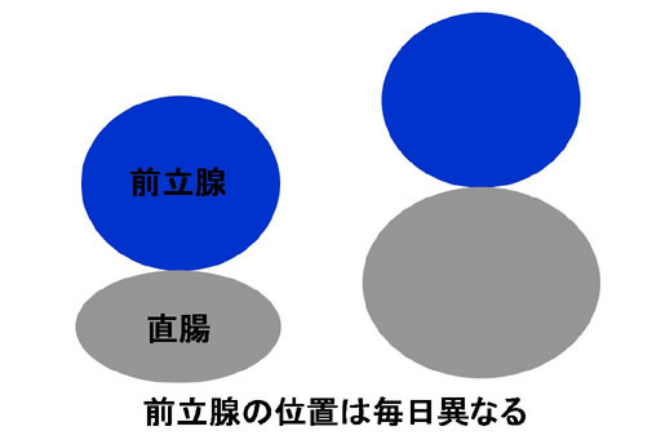 前立腺の位置は毎日異なる