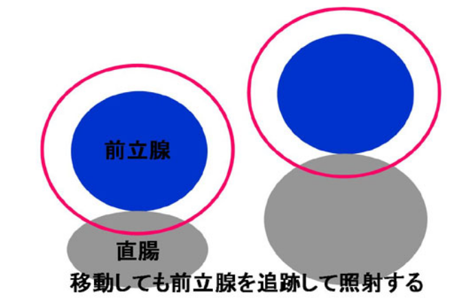 移動しても前立腺を追跡して照射する
