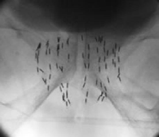 ヨウ素125を用いた前立腺がん永久挿入密封小線源療法1"