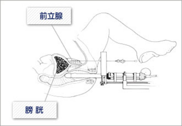 前立腺内に集中して放射線を照射する治療