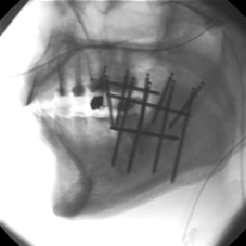 早期の口唇がん、口腔がんに対する密封小線源治療2