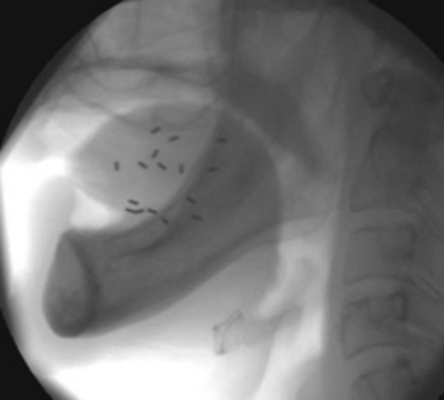 早期の口唇がん、口腔がんに対する密封小線源治療3