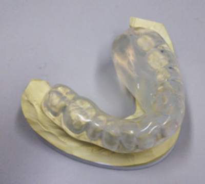 早期の口唇がん、口腔がんに対する密封小線源治療4