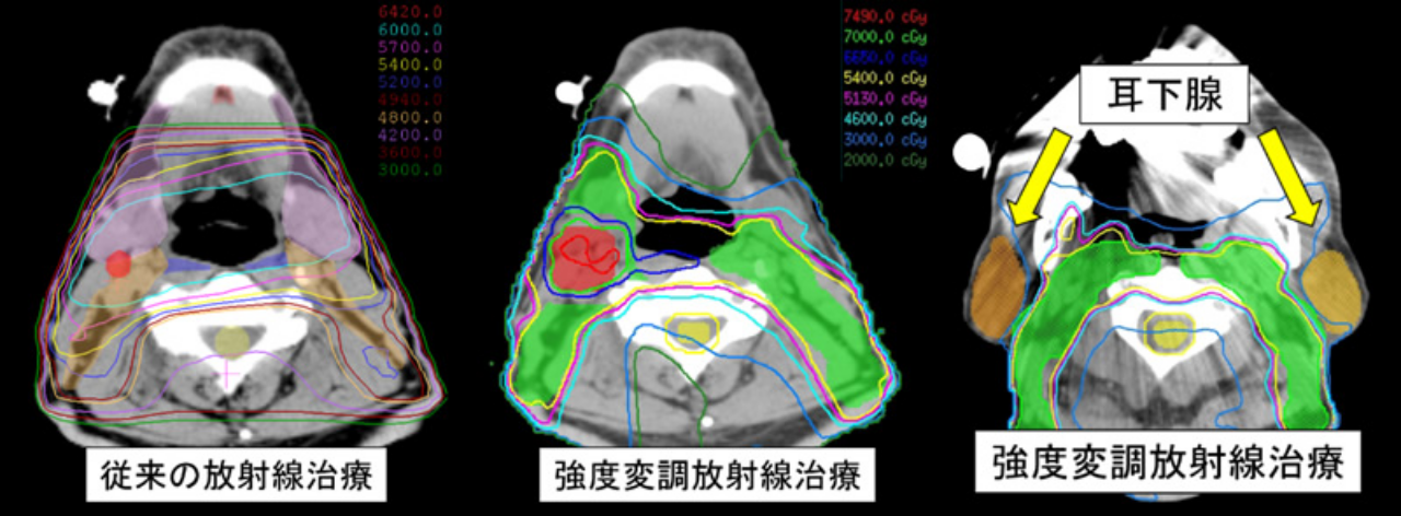 従来の放射線治療 強度変調放射線治療 耳下腺強度変調放射線治療